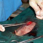 CNVR Procedure in Bangalore