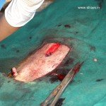 CNVR Procedure in Bangalore
